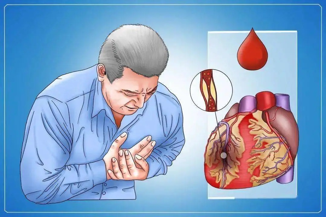 心血管堵塞是怎么引起的,预防心脏血管堵塞注意什么?