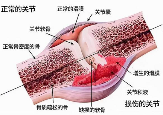 牛骨胶原蛋白肽对关节炎效果好吗？