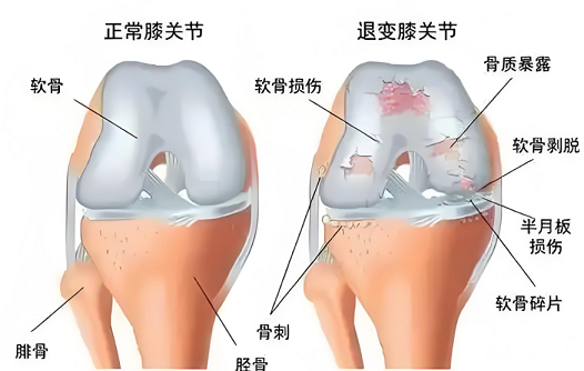 牛骨蛋白胶原肽功效,膝关节炎吃牛骨胶原蛋白肽有用吗?