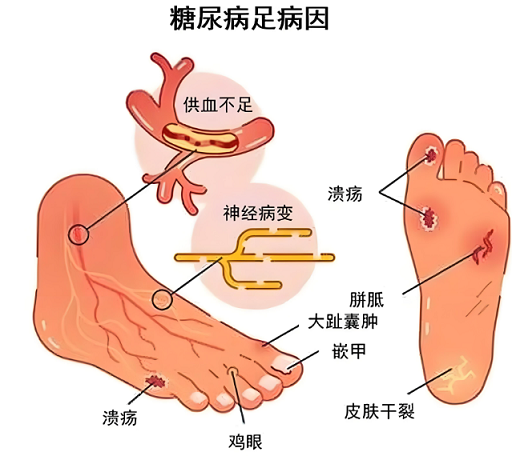 糖尿病足病是什么原因引起的,糖尿病足如何预防?