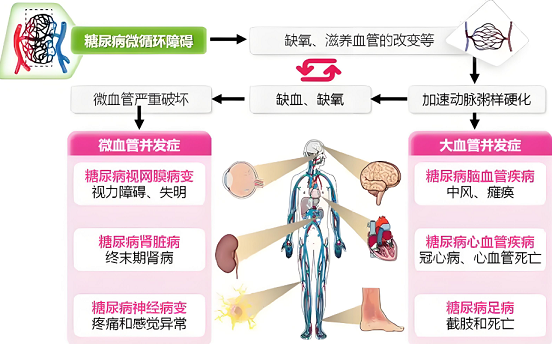 糖尿病微循环障碍的影响因素?