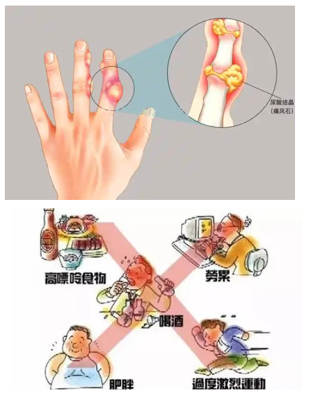 痛风尿酸高可以恢复正常吗,菊苣酸降尿酸能长期吃吗？