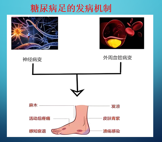 糖尿病病足形成原因,糖尿病足伤口溃烂不愈合怎么办?