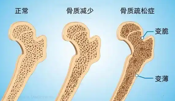 牛骨髓肽预防更年期女性骨质疏松有作用吗,应用效果如何？